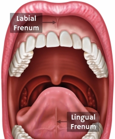 frenectomy_lingual_frenum_and_labial_frenum
